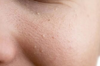 Что такое комедоны: причины, виды и методы борьбы с ними