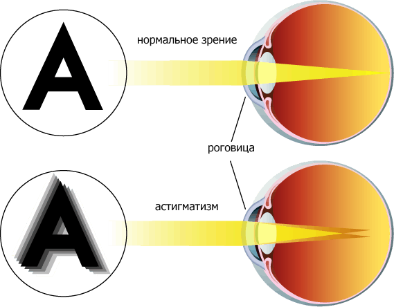 Лазерная коррекция зрения при астигматизме: цена в клинике Санта в ...