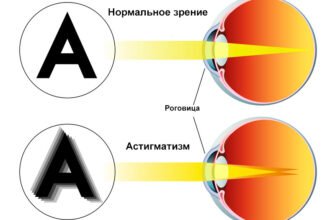 Астигматизм: основные причины, симптомы и методы коррекции зрения