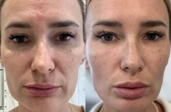 Лифтинг: что это, виды процедур и их эффективность для кожи