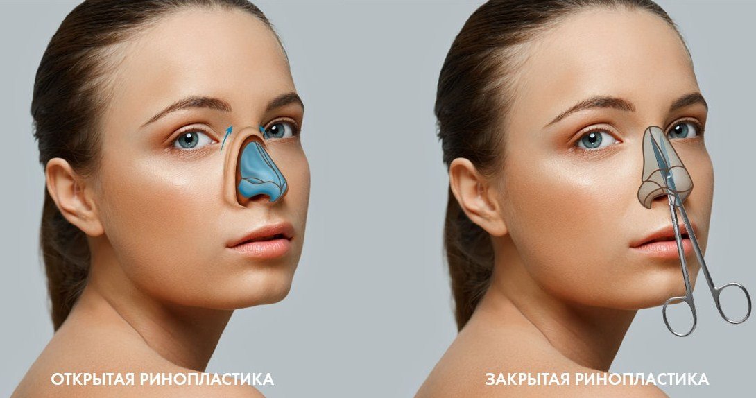 Ринопластика — Хирургический центр в Анапе — АМДЦ НЕОМЕД