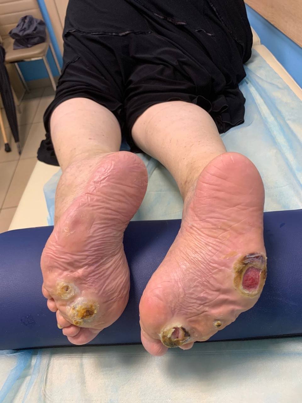 Діагностика та лікування діабетичної стопи Київ ✳️ симптоми ...