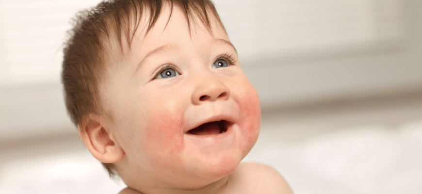 Що таке діатез: основні причини та методи лікування Що таке діатез: основні причини та методи лікування