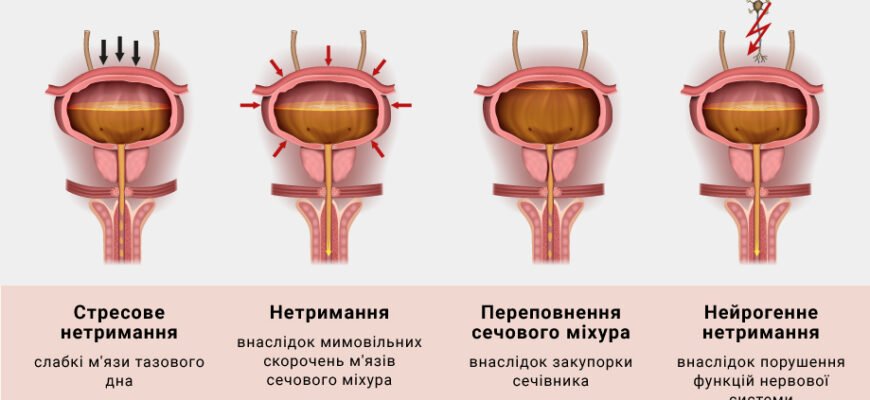 Що таке дизурія: причини, симптоми та лікування