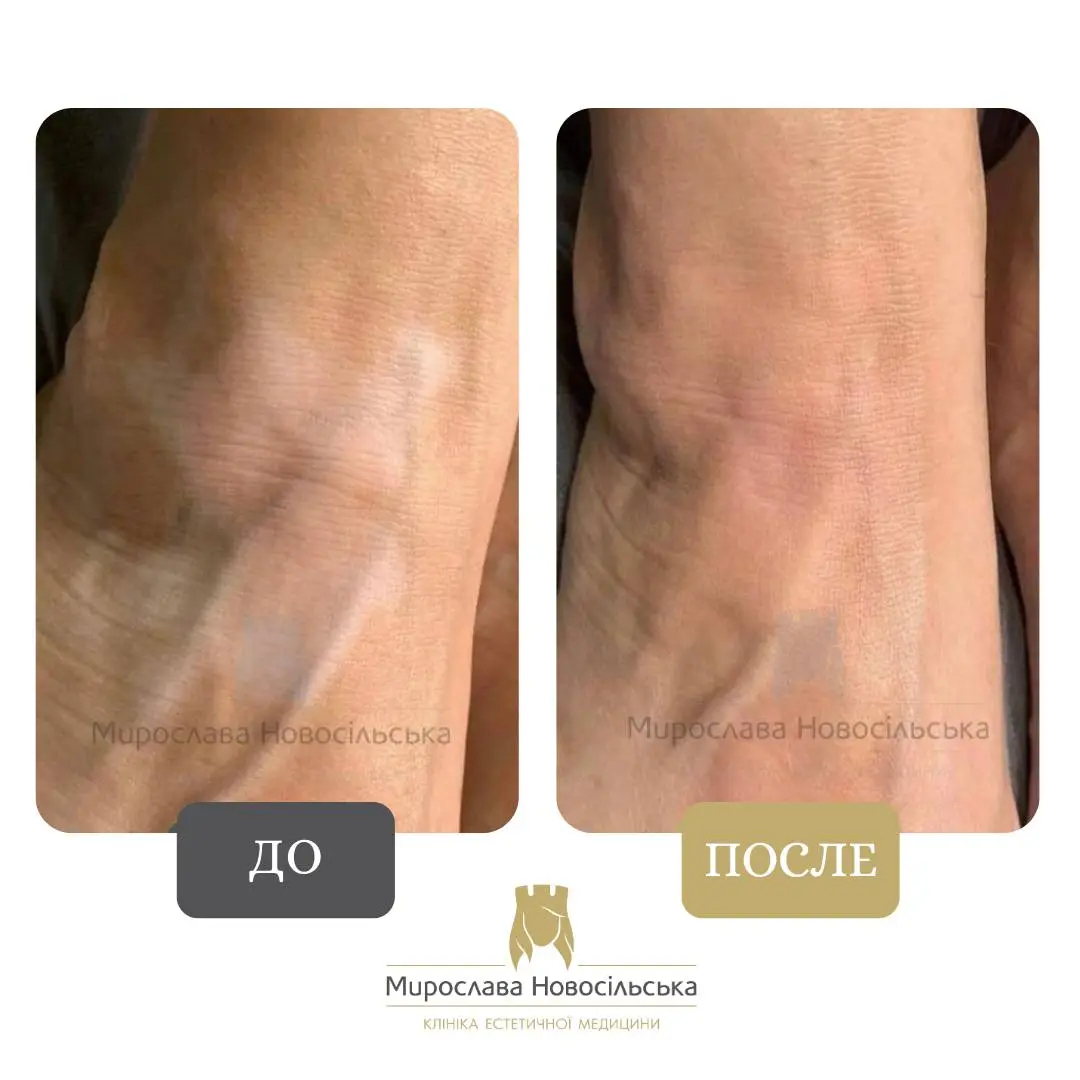 Болезнь витилиго: причины и лечение витилиго в Москве