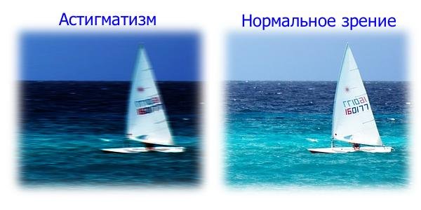 Астигматизм: что это такое, симптомы и лечение