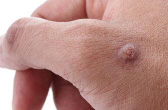 Ефективна кислота для видалення бородавок: перевірені методи лікування