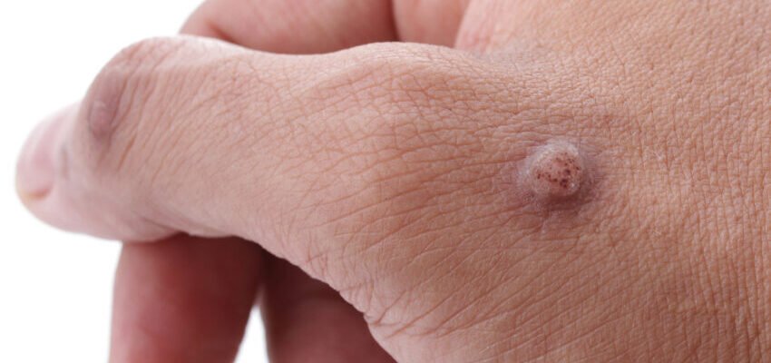 Ефективна кислота для видалення бородавок: перевірені методи лікування