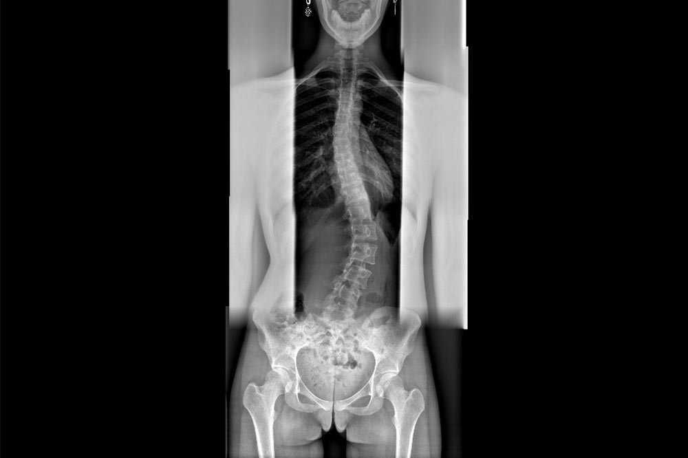 Профілактика сколіозу у дітей - Медичний центр лікування ...