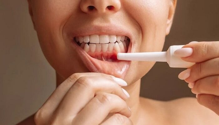 Ефективні ліки для лікування стоматиту в роті: рекомендації та поради