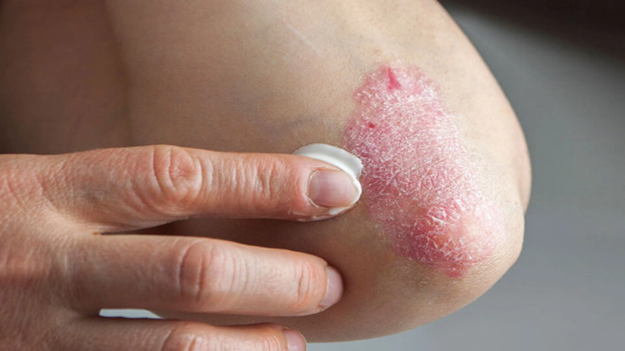 Екзема, пов'язана зі стресом: симптоми, види та методи лікування ...