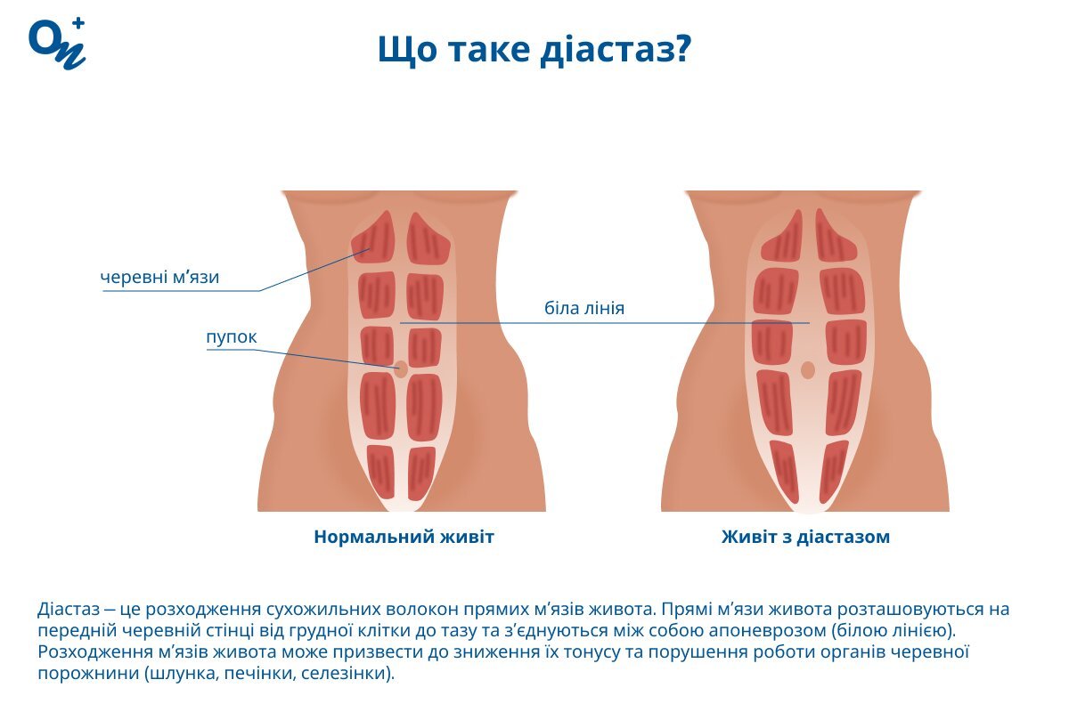 Діастаз м'язів живота: як виглядає живіт, які причини діастазу, як ...