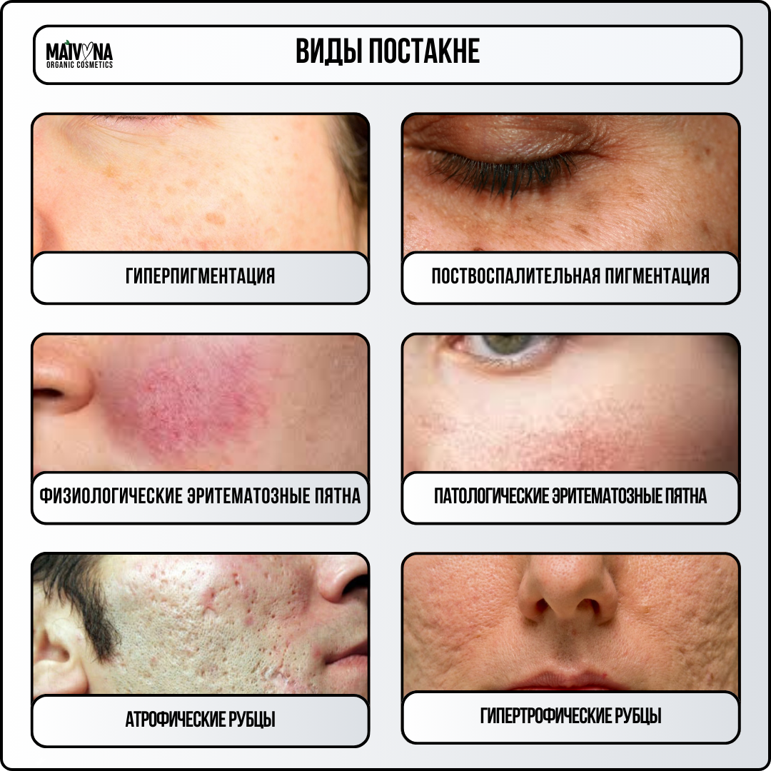 Як прибрати плями та шрами після прищів? ✔️ Що робити для ...