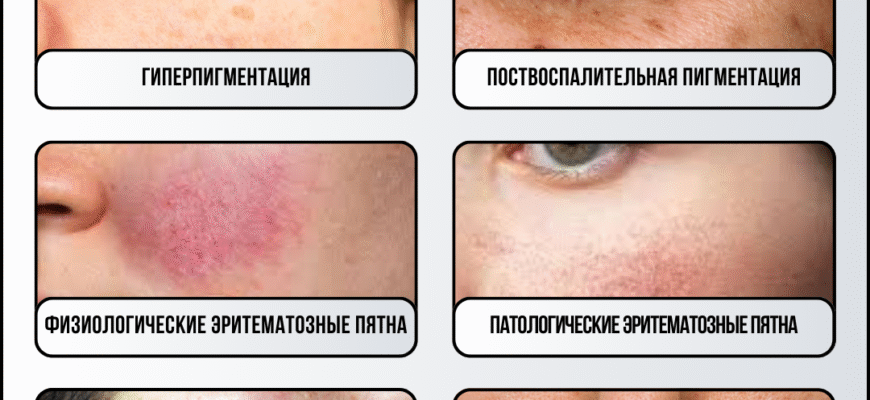 Як ефективно позбутися темних плям на шкірі після прищів: поради та засоби