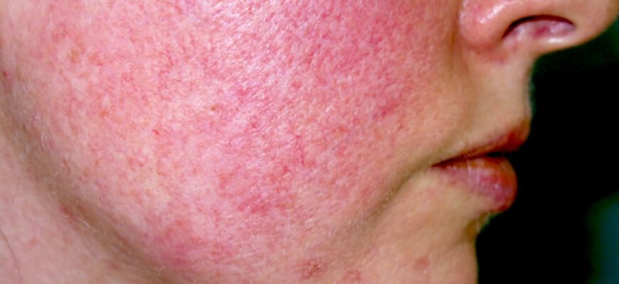 Як Позбутися Куперозу на Обличчі: Ефективні Методи та Поради