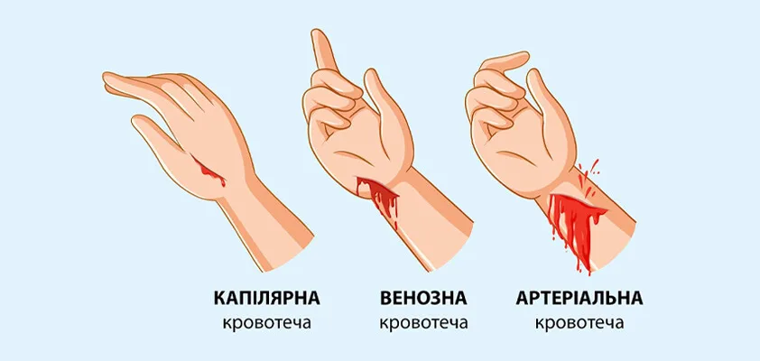 Який тип кровотечі: залежить від ушкодженої судини? Дізнайтеся більше!